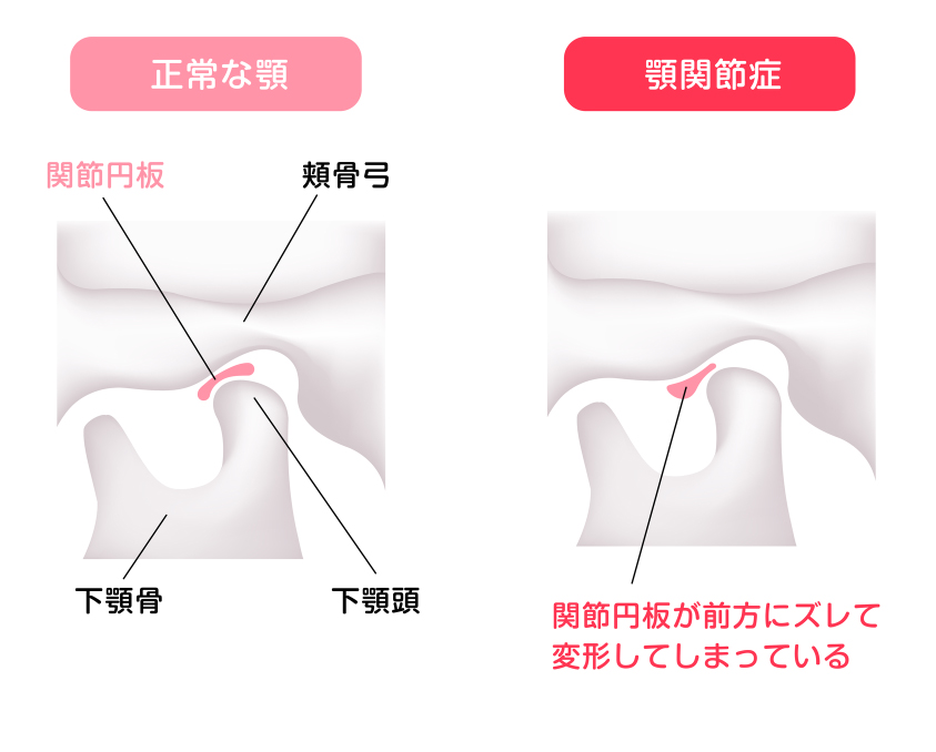 正常な顎と顎関節症