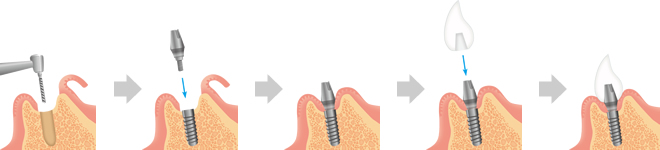 インプラントの治療