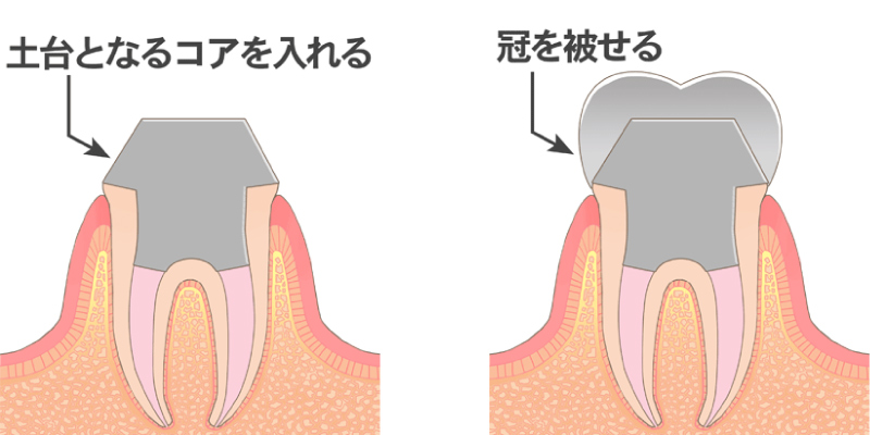 歯の部分（歯冠）が破壊してしまった場合