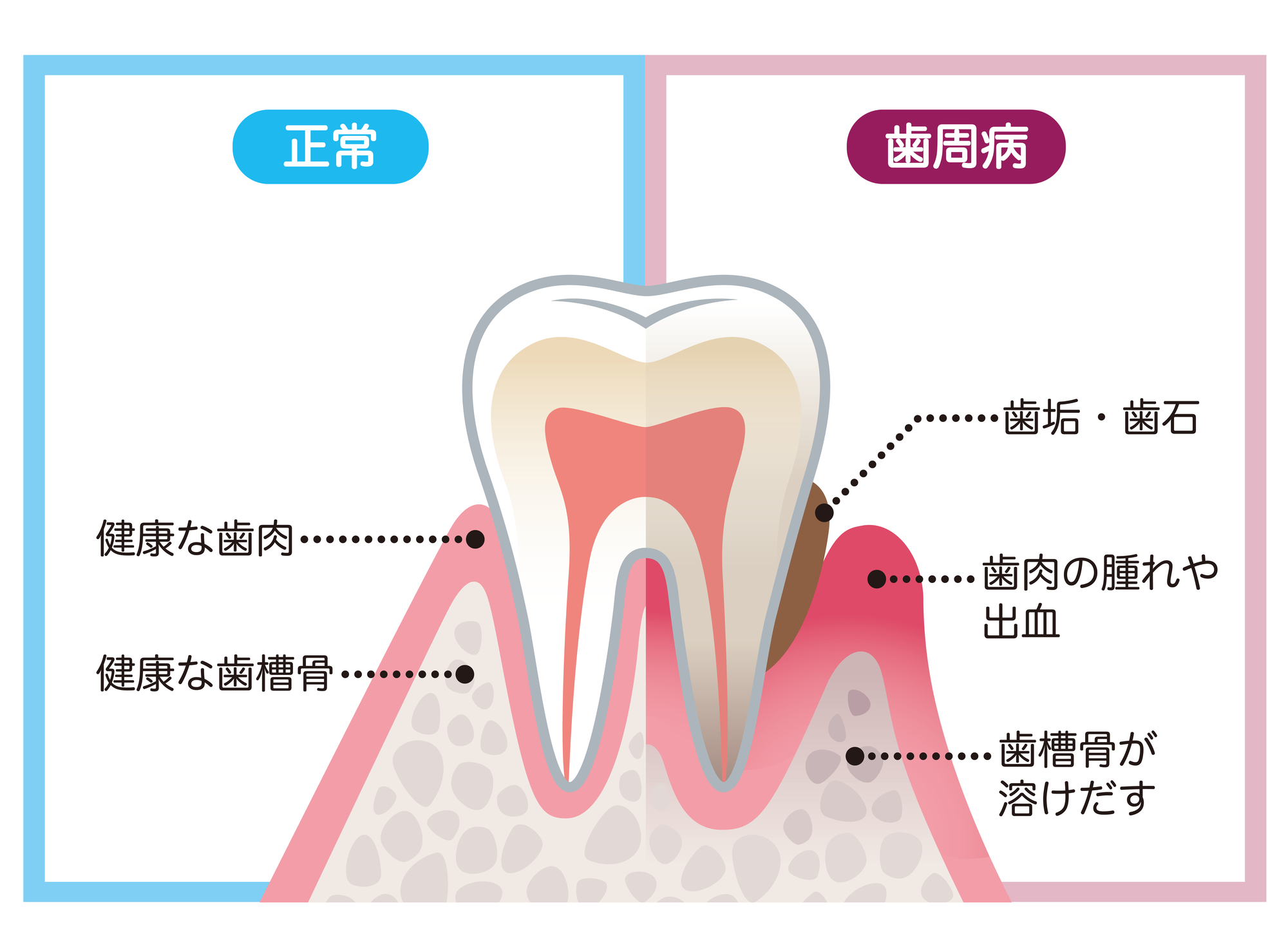 歯周病治療