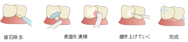 歯のクリーニングの流れ